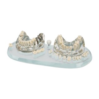 Studienmodell Demo Implant C+B St