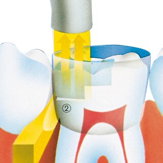 Prämolarbänder transp. 773  Nfpa