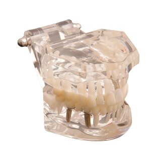 Studienmodell f. Zahnkrankheiten  St