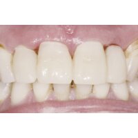 Fixtemp C&B A3 Kartusche 4:1  50ml