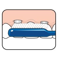 TePe Implant Care St