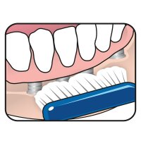 TePe Implant Care St